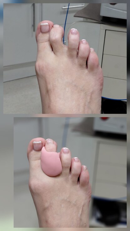 Antes y después de una ortesis de silicona de Clínica Podogral
