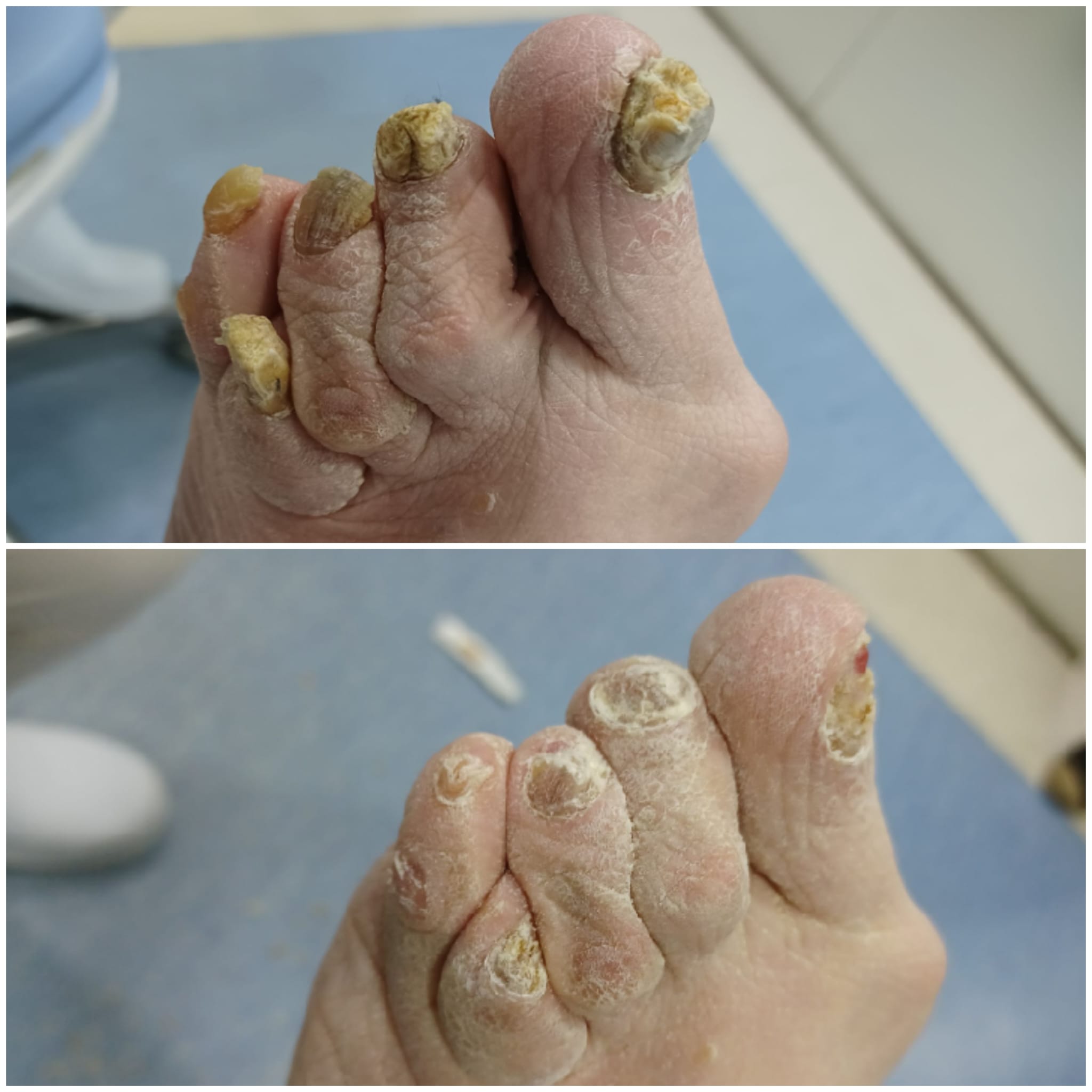 Tratamiento podológico para tercera edad en Podogral - imagen 1